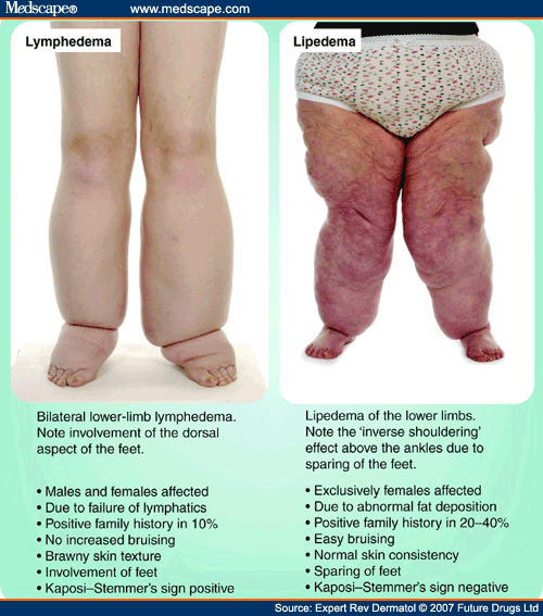 What are some treatment options for lipedema?